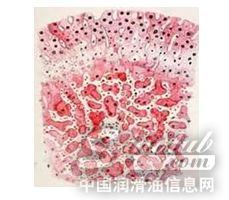 毒血癥所引起的肝部細(xì)胞死亡